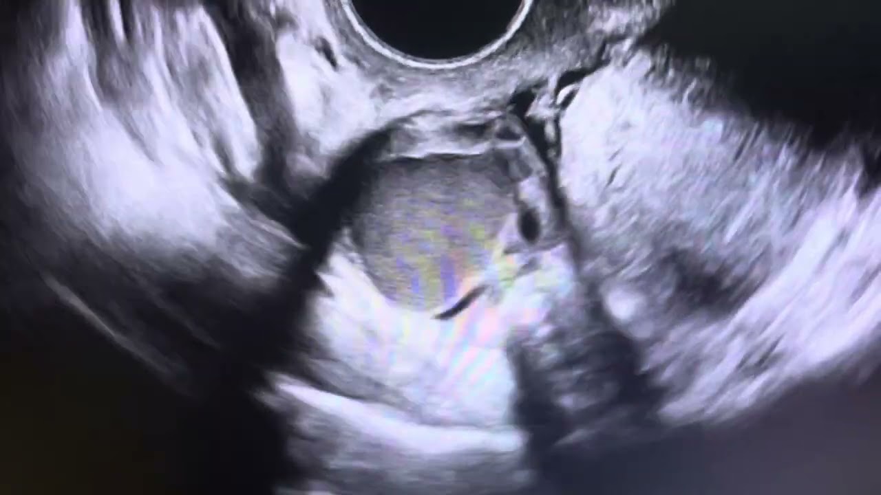 Endometrioma cyst, endometriosis ultrasound, typical low level echo, ground glass sonography, ARDMS