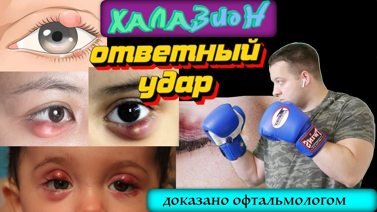 Халазион - Ответный удар