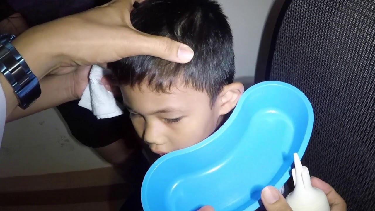 Little Boy's Hard Dry Earwax Removed after 3 days of Earwax Softener at Home