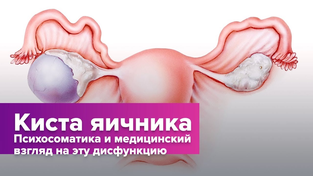 Киста яичника. Психосоматика и медицинский взгляд на эту дисфункцию
