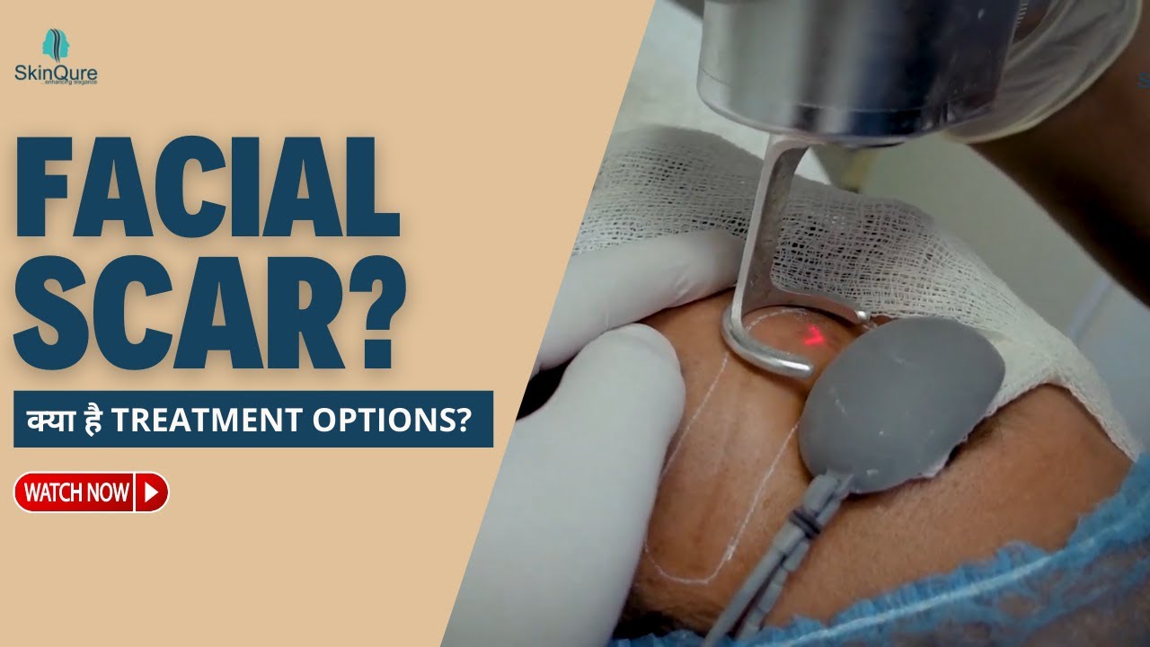 CO2 Laser for Facial Trauma Scar | Know the Treatment options? | SkinQure
