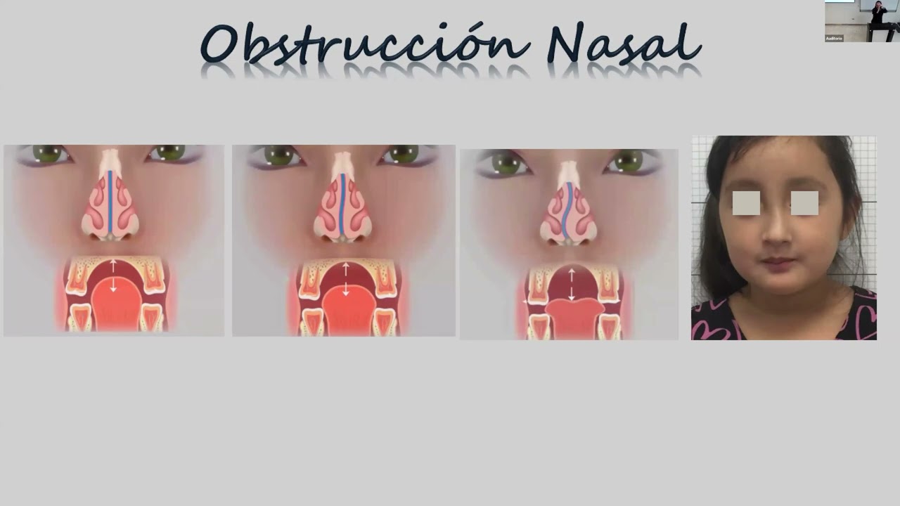 Transtornos respiratorios en niños y sus abordajes