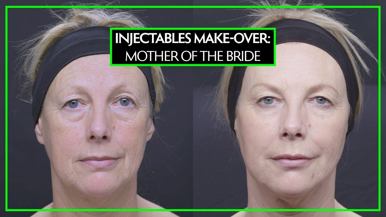Injectables Make-Over For the Mother Of The Bride