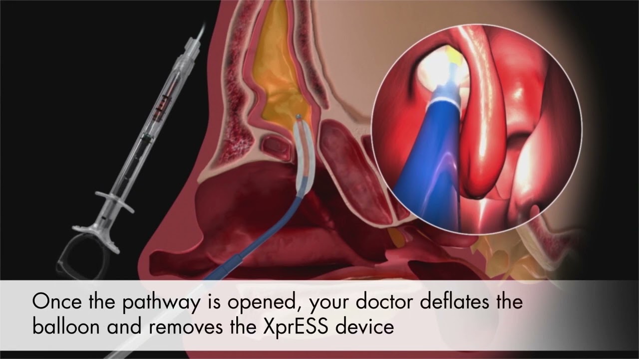 Sinus Dilation Animation For Patients | Northeast Atlanta ENT