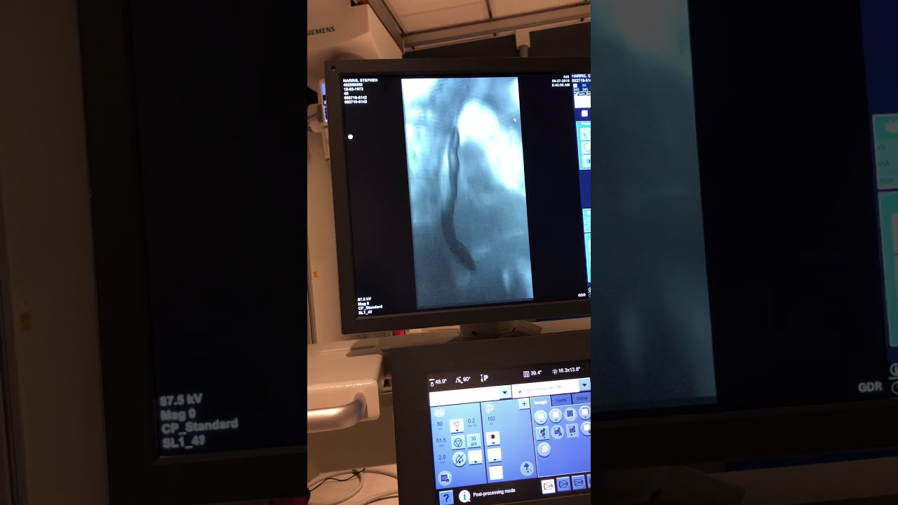 Barium Swallow - Esophagram
