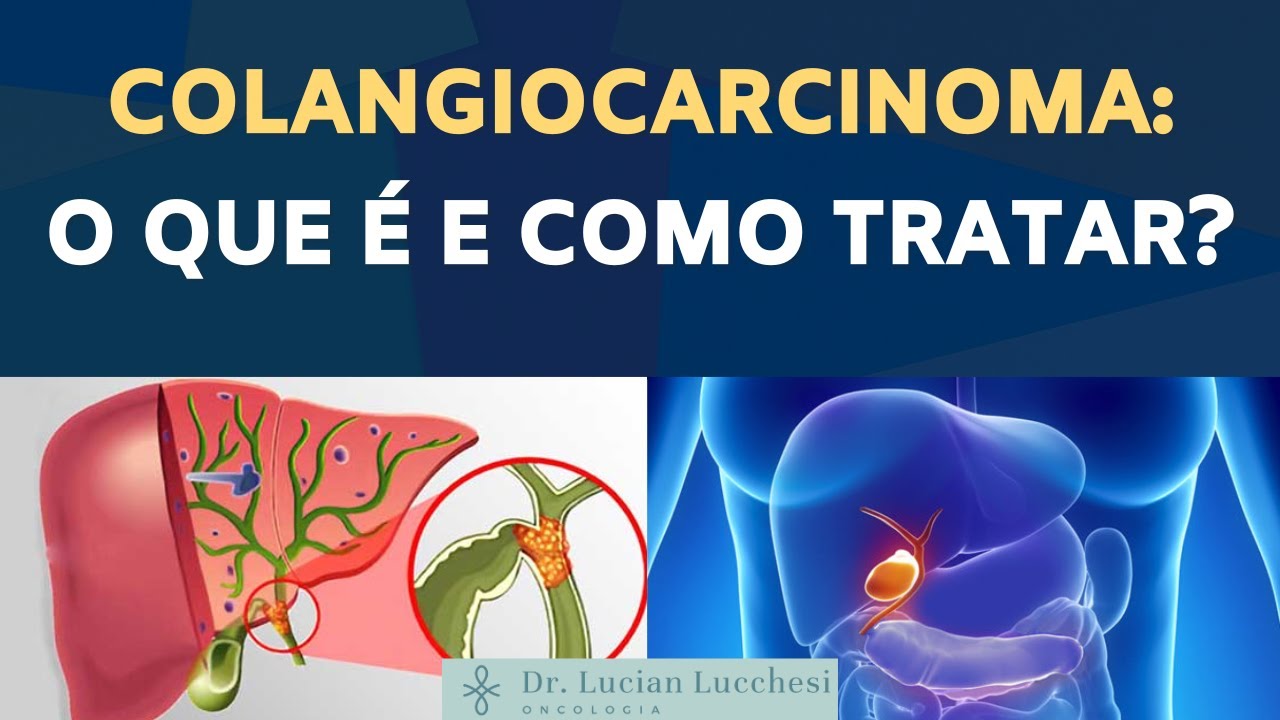 COLANGIOCARCINOMA (câncer de vias biliares): o que É e como TRATAR??