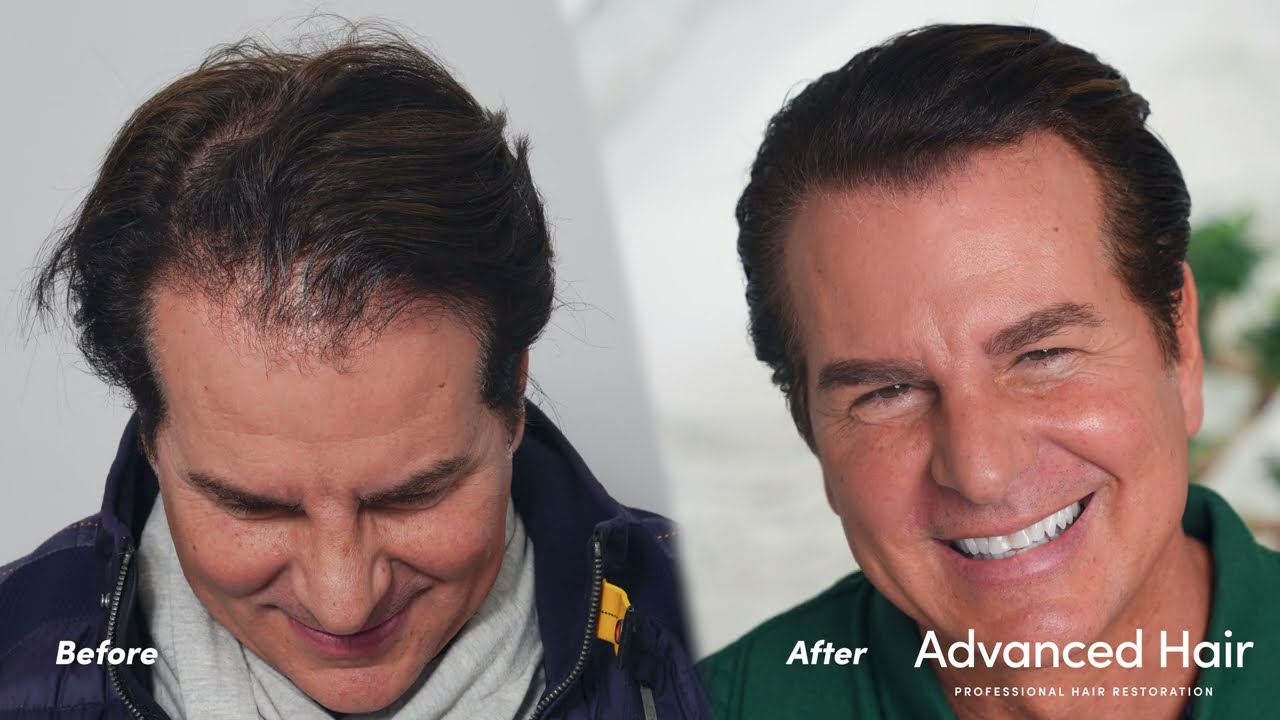 Vincent De Paul Hollywood Hair Transplant | Advanced Hair