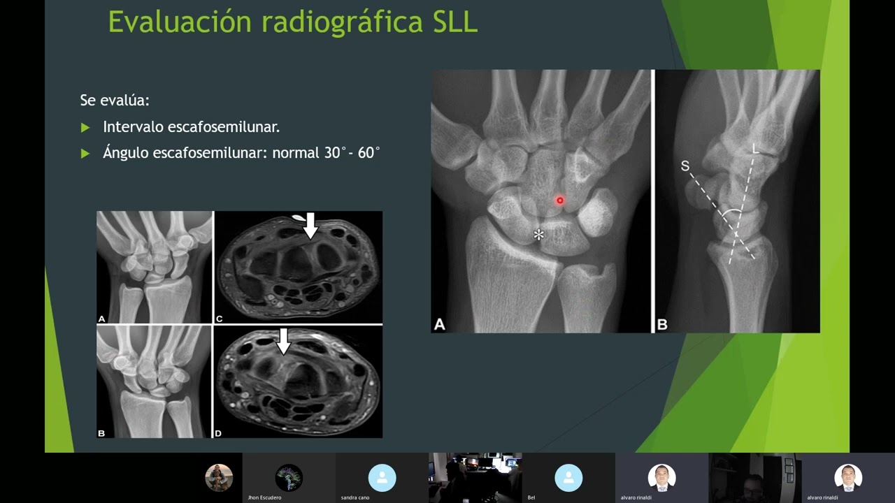 Ligamento Escafosemilunar  evaluación pre y post operatoria