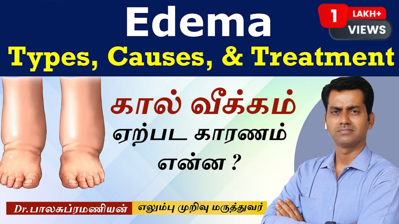 கால்வீக்கம் ஏற்பட காரணம் என்ன? Edema, Causes, Signs and Symptoms, Diagnosis and Treatment in tamil