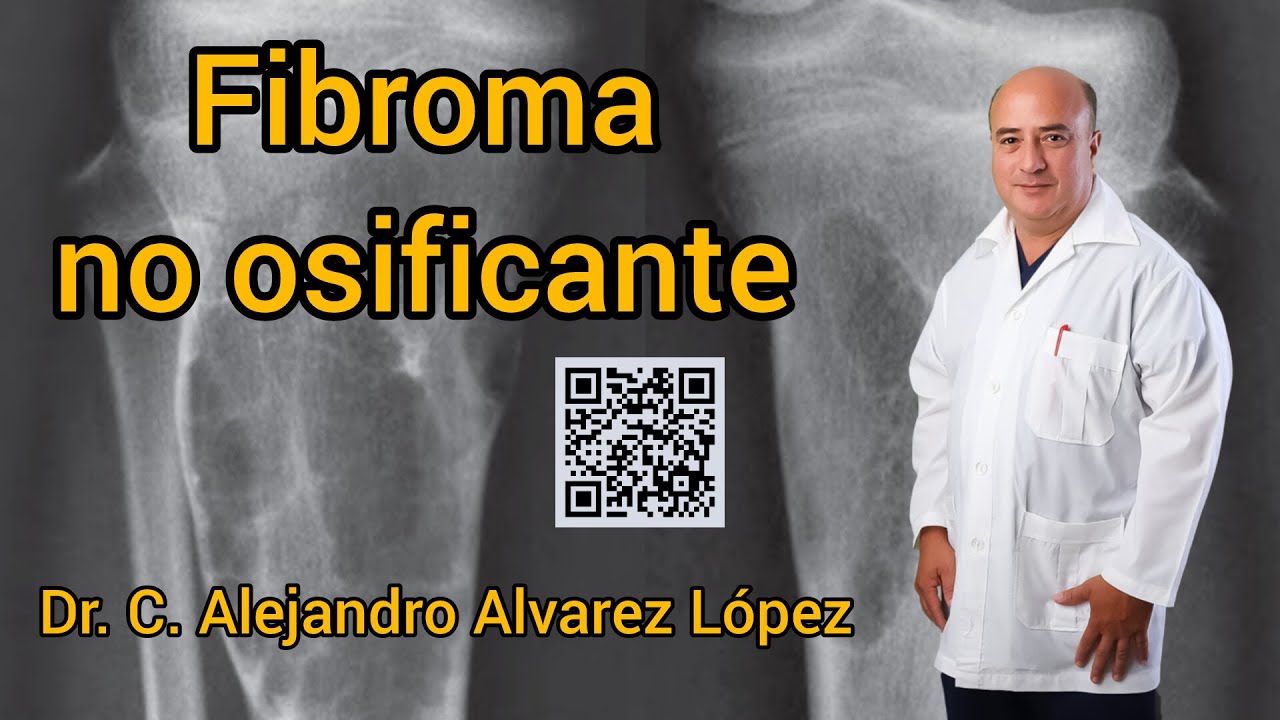 Fibroma no osificante