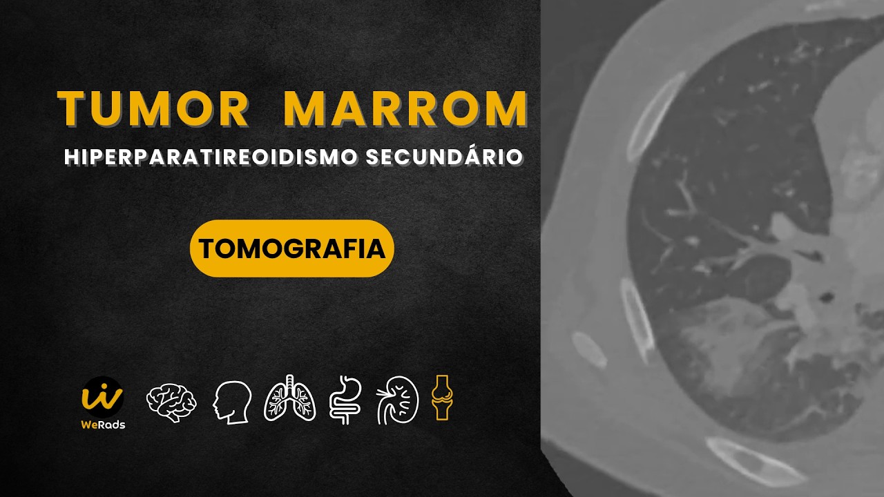 Hiperparatireoidismo com Tumor Marrom em Nefropatia Crônica
