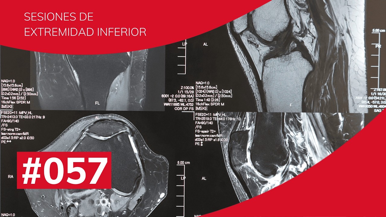 Tendinopatías cadena anterior | Carlos Cabrelles