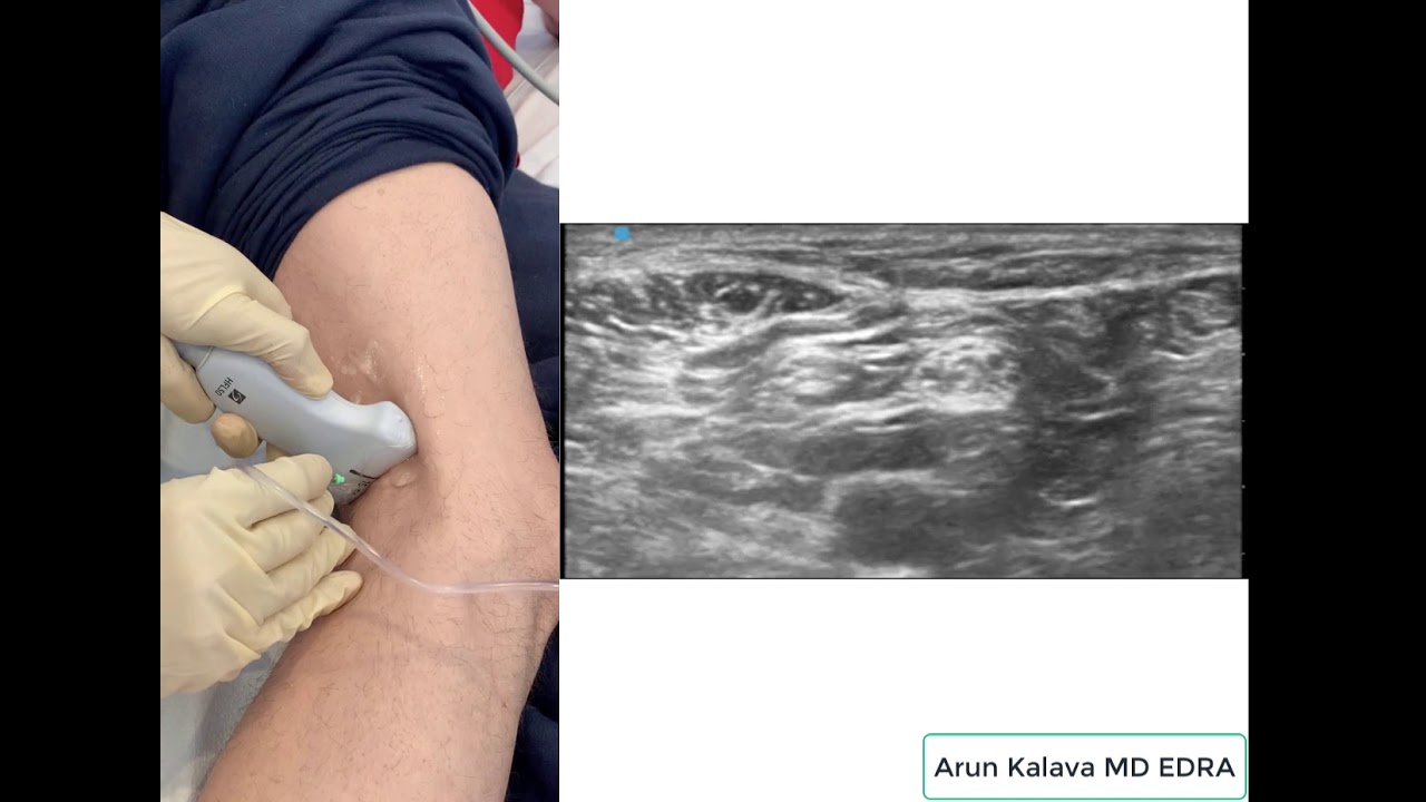 Popliteal Sciatic Nerve Block: Out of Plane Approach