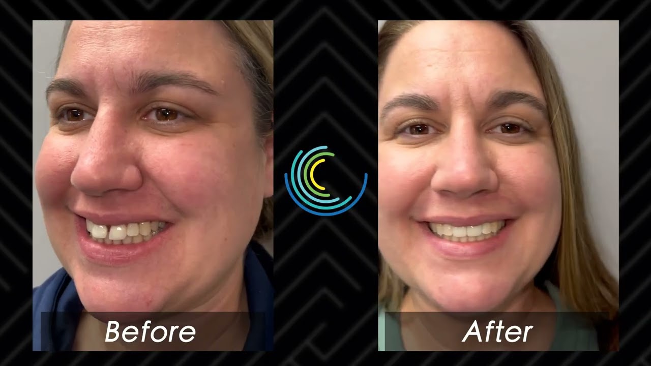 Brittany's Smile Transformation: From self-conscious to absolutely stunning | Cleveland Smile Center