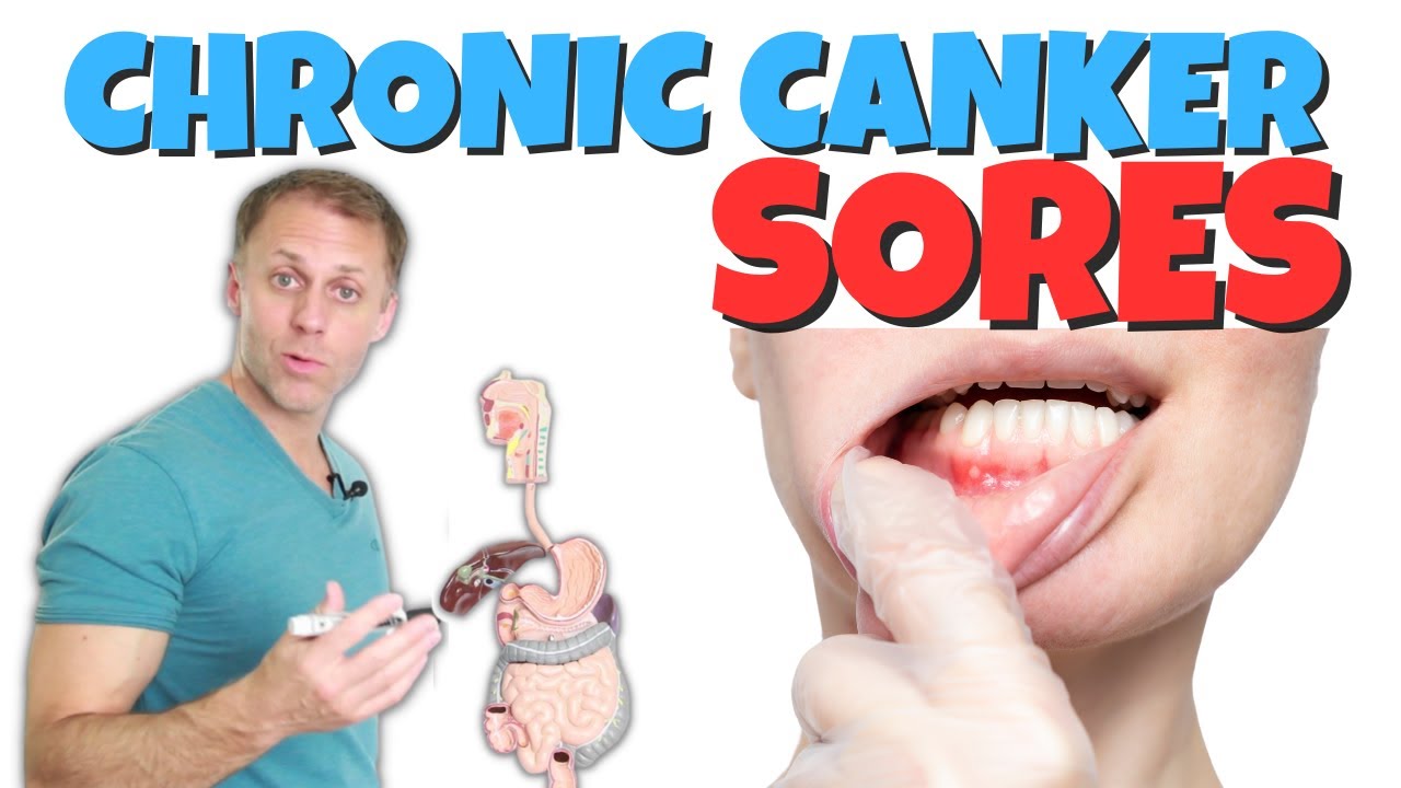 Dealing with Chronic Canker Sores