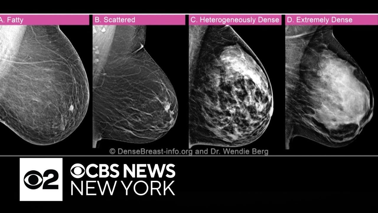 Columbia University School of Nursing dean says breast density camouflaged her cancer