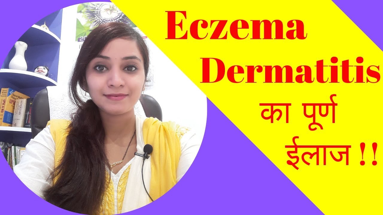 Eczema treatment | eczema homeopathic medicine | dermatitis  treatment | eczema cream in homeopathy