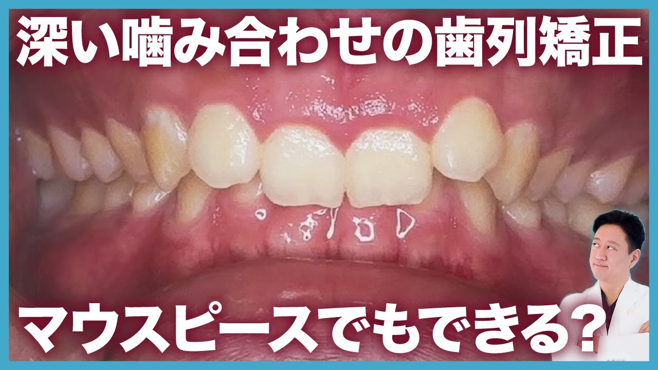 出っ歯の矯正！深い噛み合わせはマウスピース矯正や裏側矯正でも治せる？【審美歯科 歯列矯正 歯並び ディープバイト】