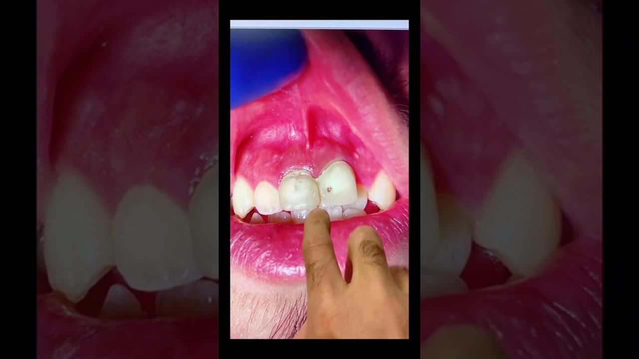 Is that something? #dentists #rootcanaltherapy 