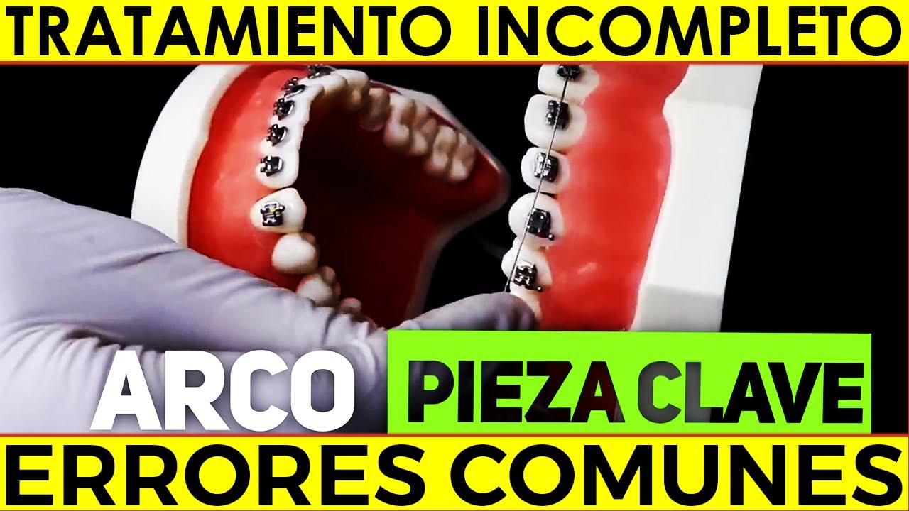 Riesgos de un MAL TRATAMIENTO de ORTODONCIA | Cambiar el ARCO y las LIGAS para MEJORES RESULTADOS