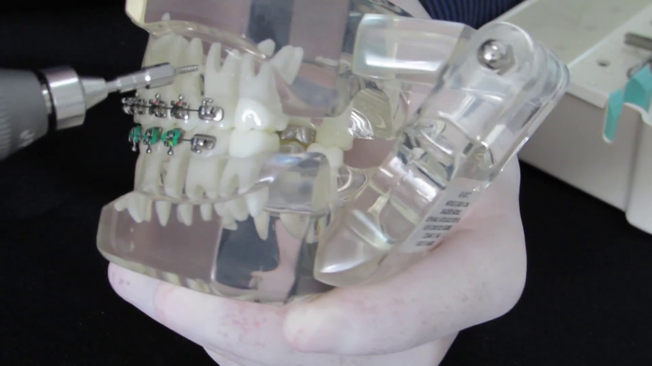 Falando um pouco sobre Mini implantes Ortodônticos