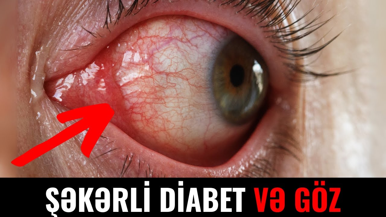 Şəkərli Diabet xəstələrində hansı Göz Xəstəlikləri yarana bilər?