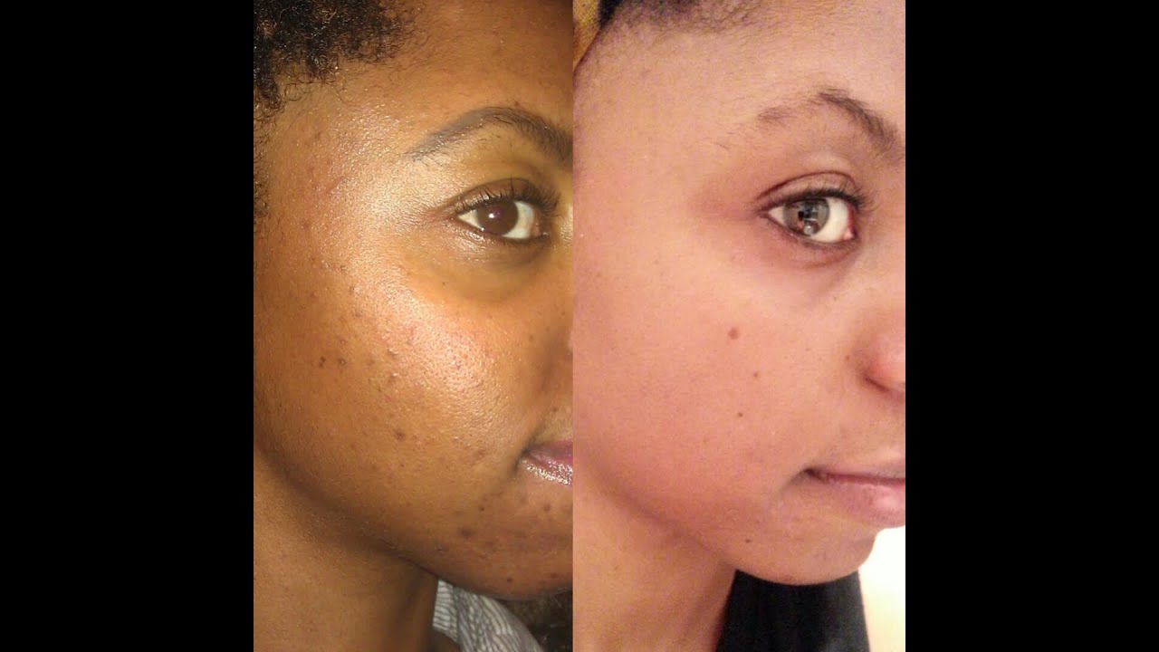 Homemade acne treatment || HIGHLY REQUESTED