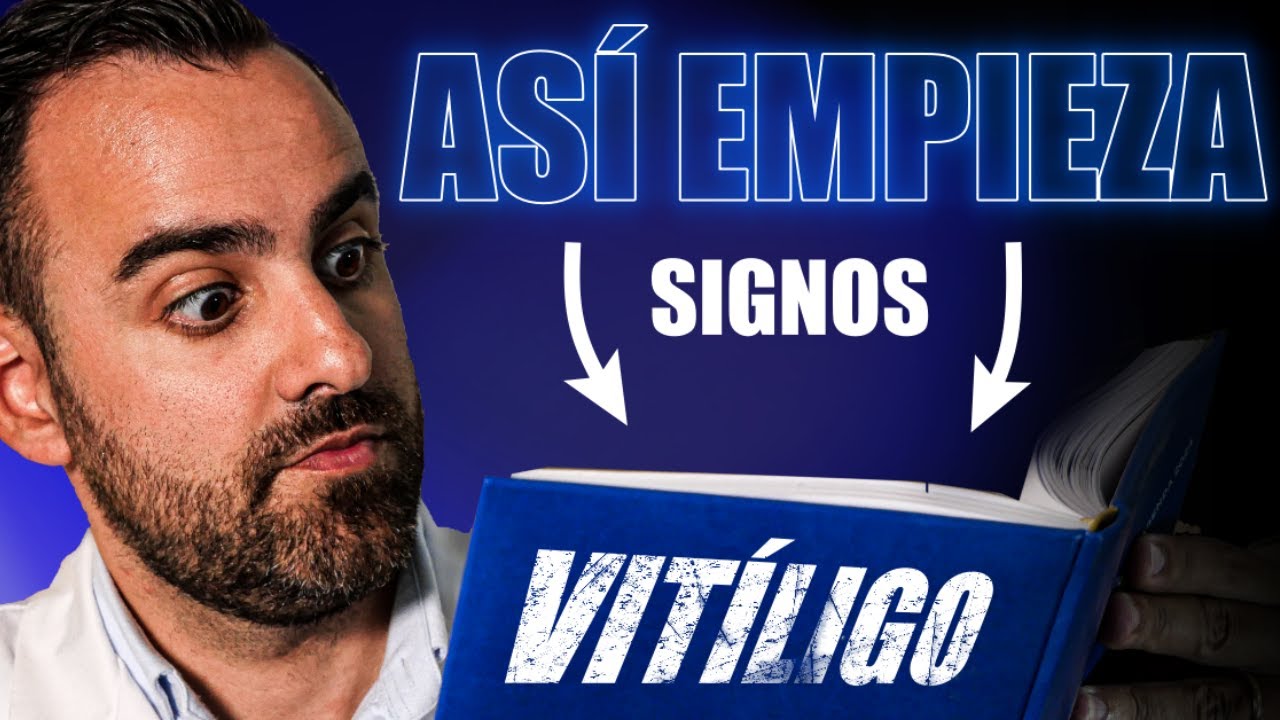 Vitiligo: Cómo Empieza y 3 CONSEJOS Para Mejorarlo 🔵