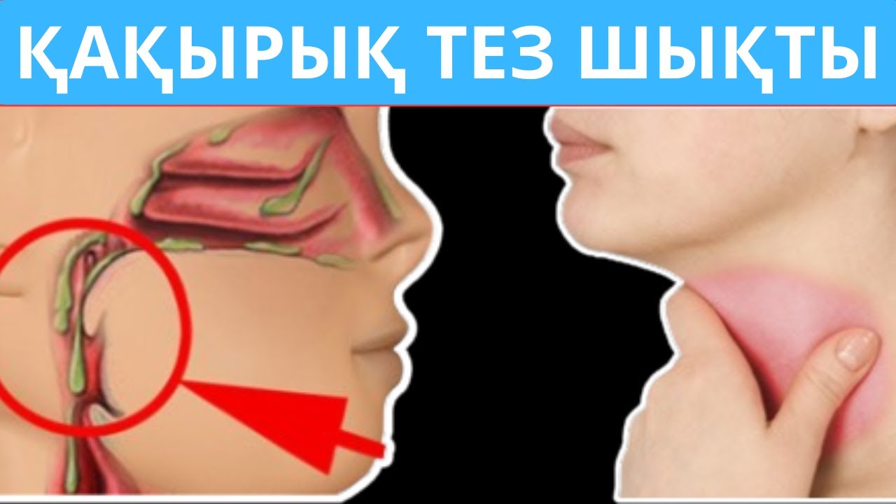 Қақырық түсіру үй жағдайында. Қақырық ТАМАҚТАН 1 КҮНДЕ ЗЫТЫП ШЫҚТЫ