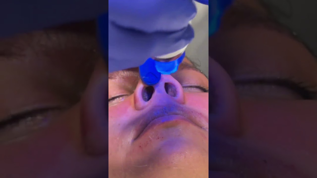 Microneedling (Collagen Induction Therapy)