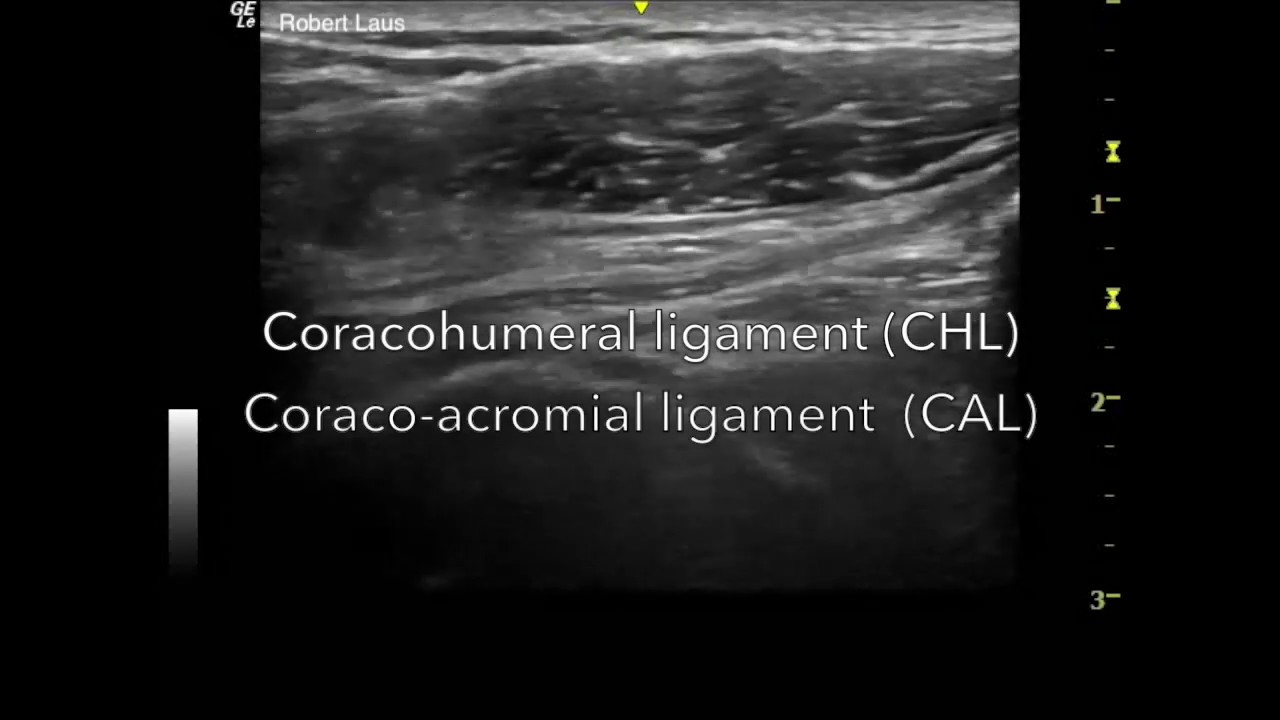 Coraco-humeral ligament & Coraco-acromial ligament. Dynamic ultrasound.