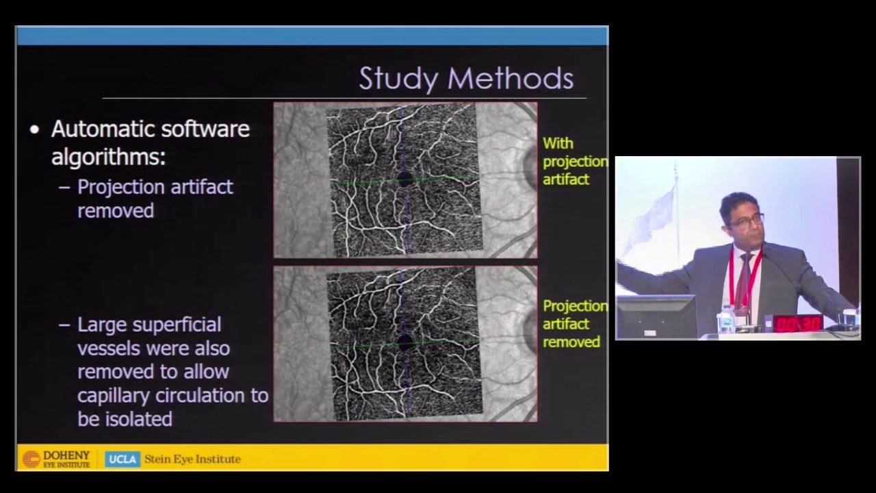 Unraveling the Layers of the Macular Circulation with OCT Angiography