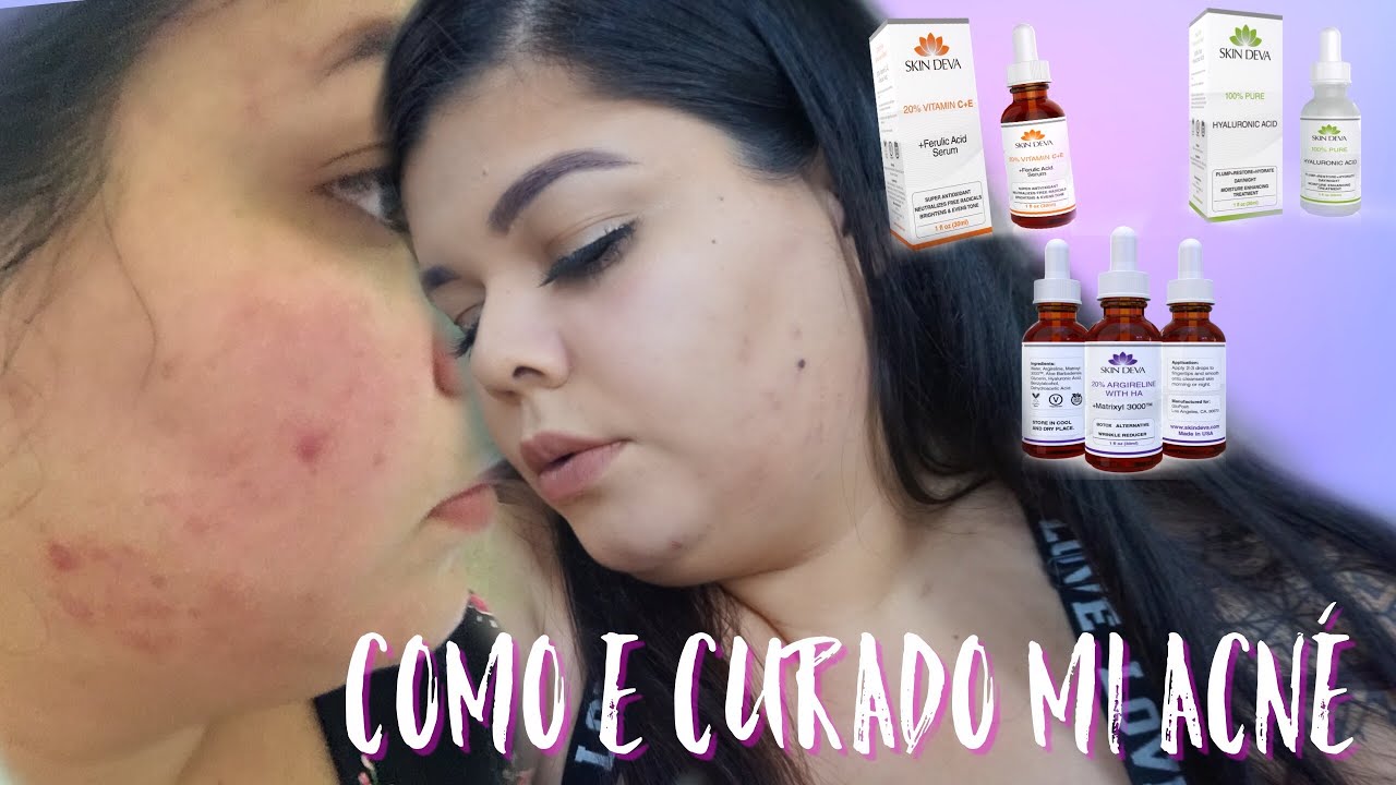 ELIMINA EL ACN&Eacute;!/ Desiree Marie