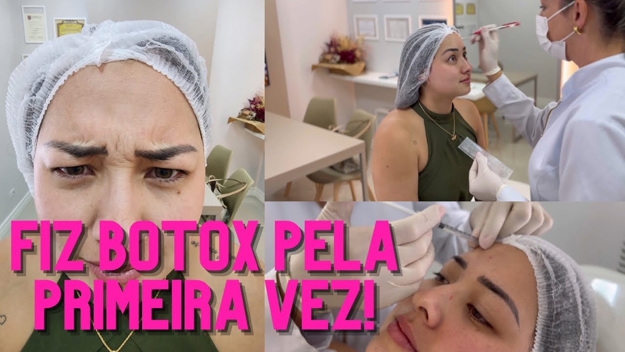 FIZ BOTOX PELA PRIMEIRA VEZ!!! ANTES E DEPOIS - como foi? Doeu? Conto tudo!!!