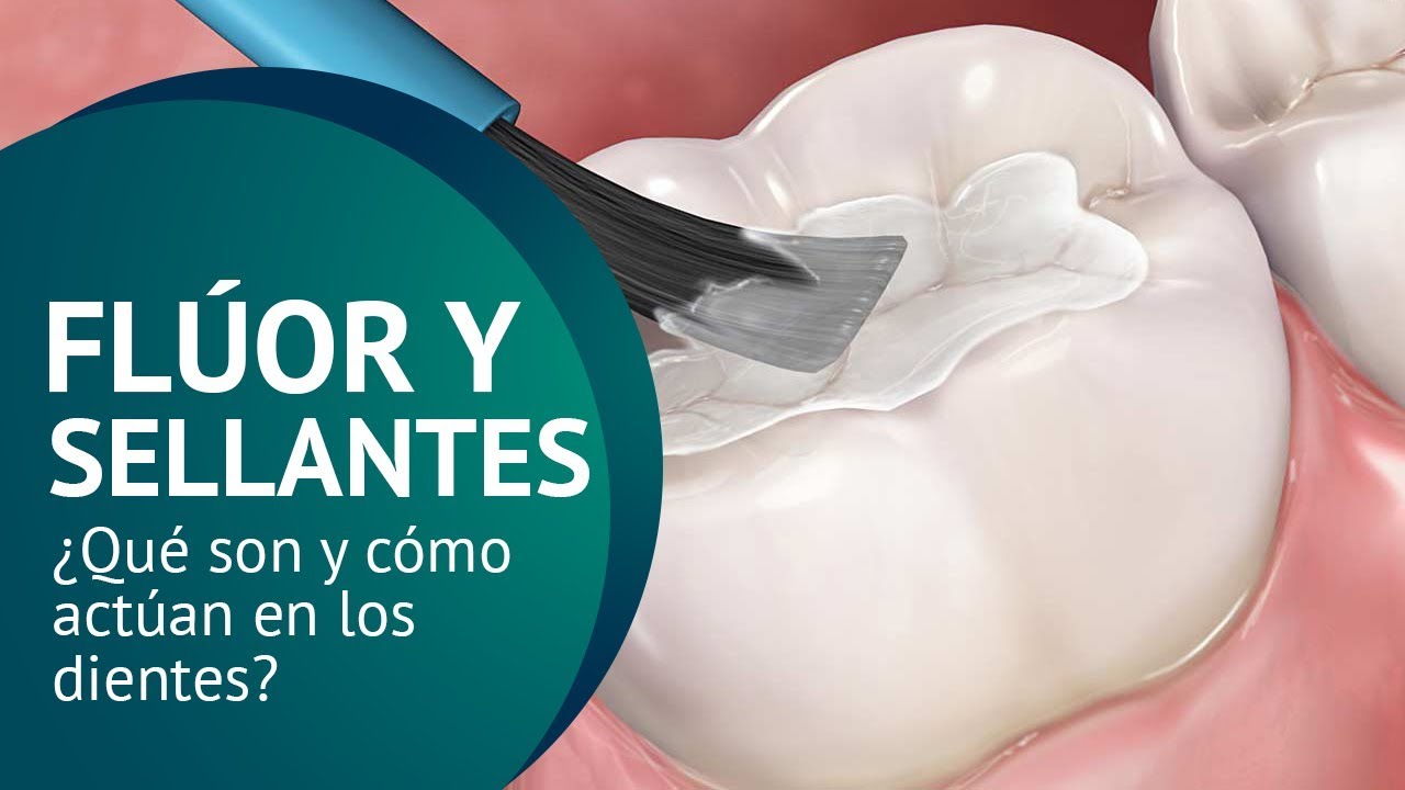 ¿Qué es el Flúor? | Juan Salgado | ¿Qué son los sellantes dentales? | Que es el fluor