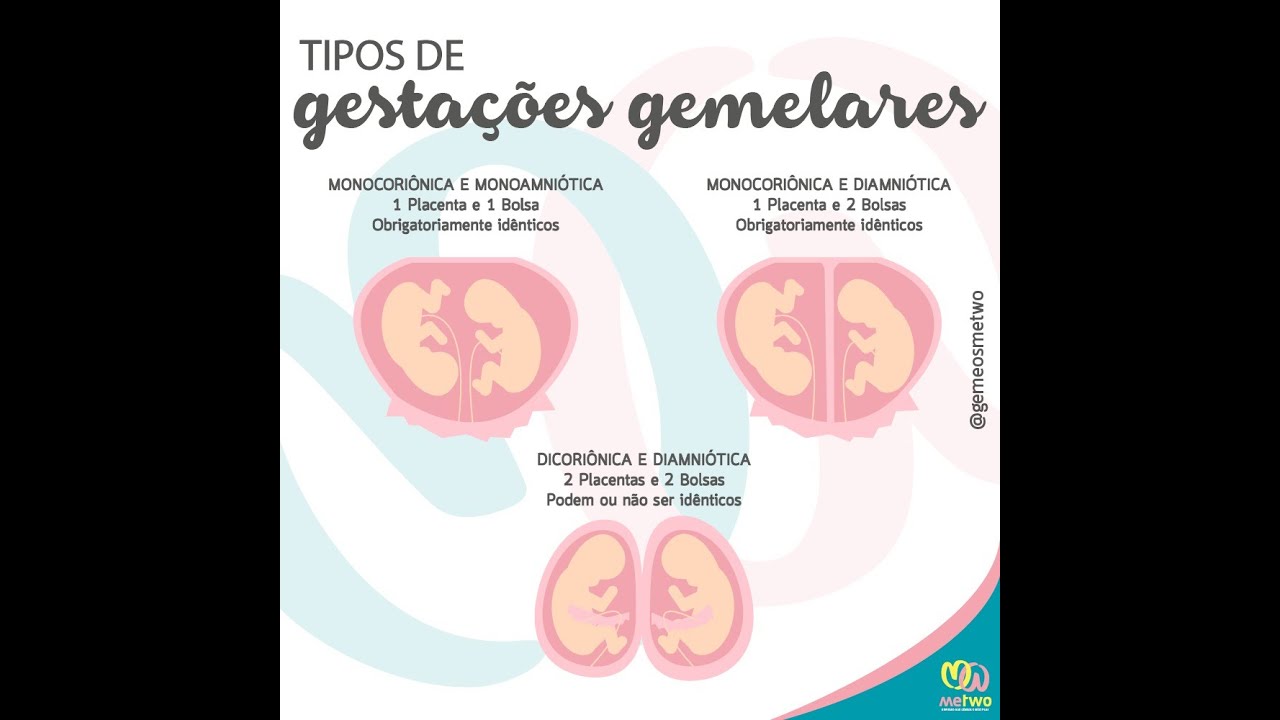 Tipos de gestações gemelares e a STFF - Síndrome de transfusão feto fetal.
