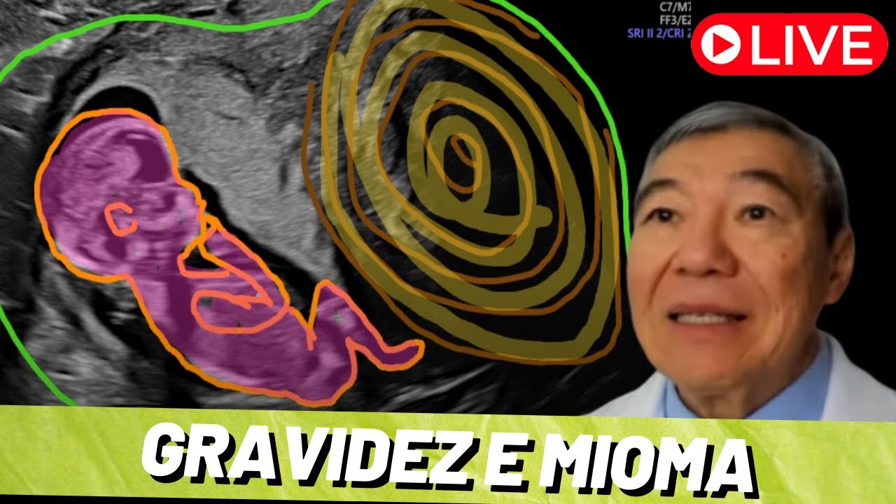 AO VIVO: MIOMA E GRAVIDEZ!