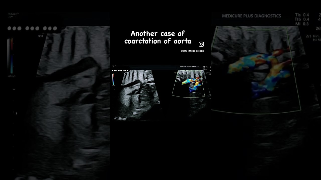 Coarctation of aorta #fetalmedicine #fetalecho #ultrasound #isuog #fetalmedicine #fetal