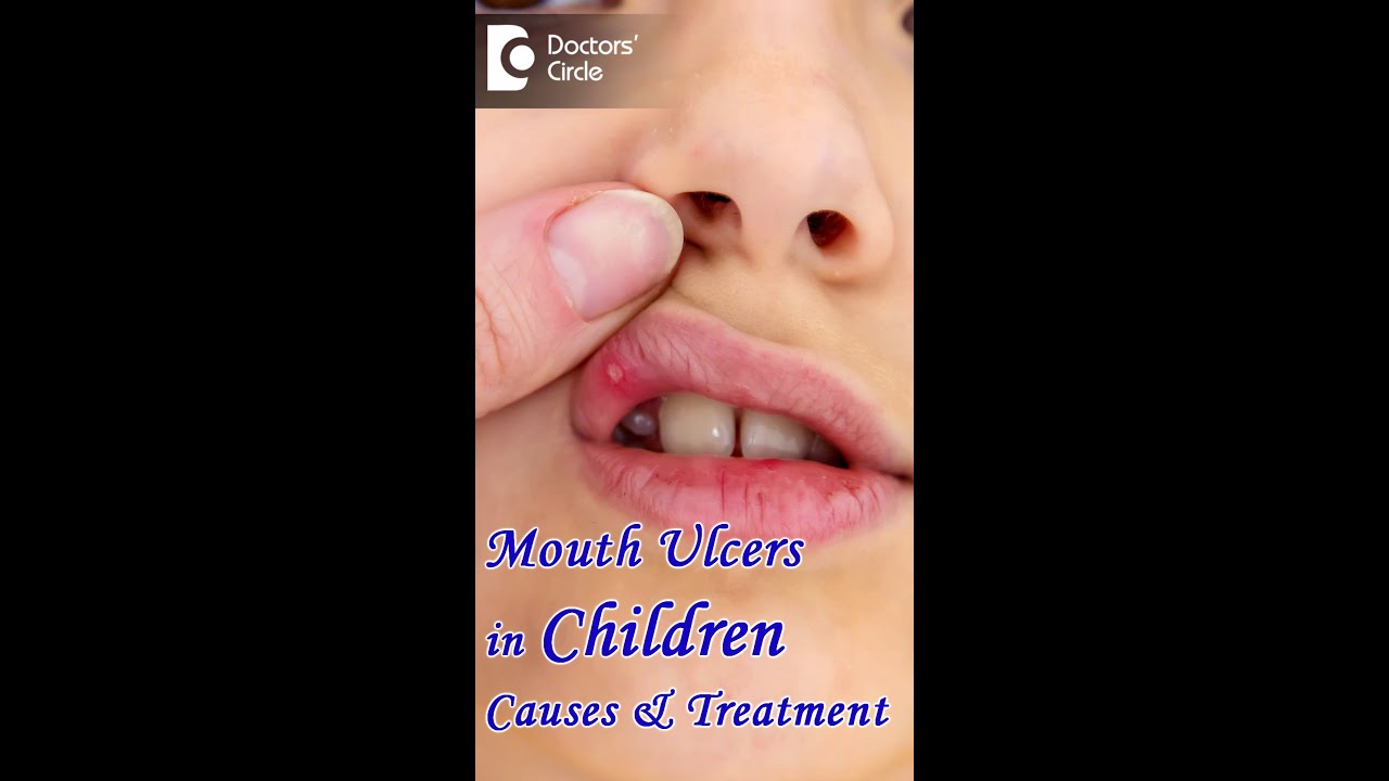 Mouth Ulcers in Children  Causes & Treatment - Dr. K Saranya |Doctors' Circle #shorts
