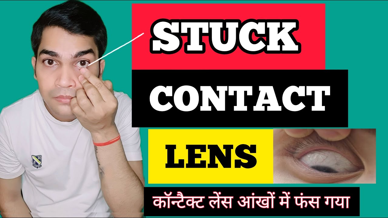 How to Remove a Contact Lens Stuck in Your Eye - EASY steps- कैसे निकाले आंखों में फंसा कॉन्टैक्ट ?