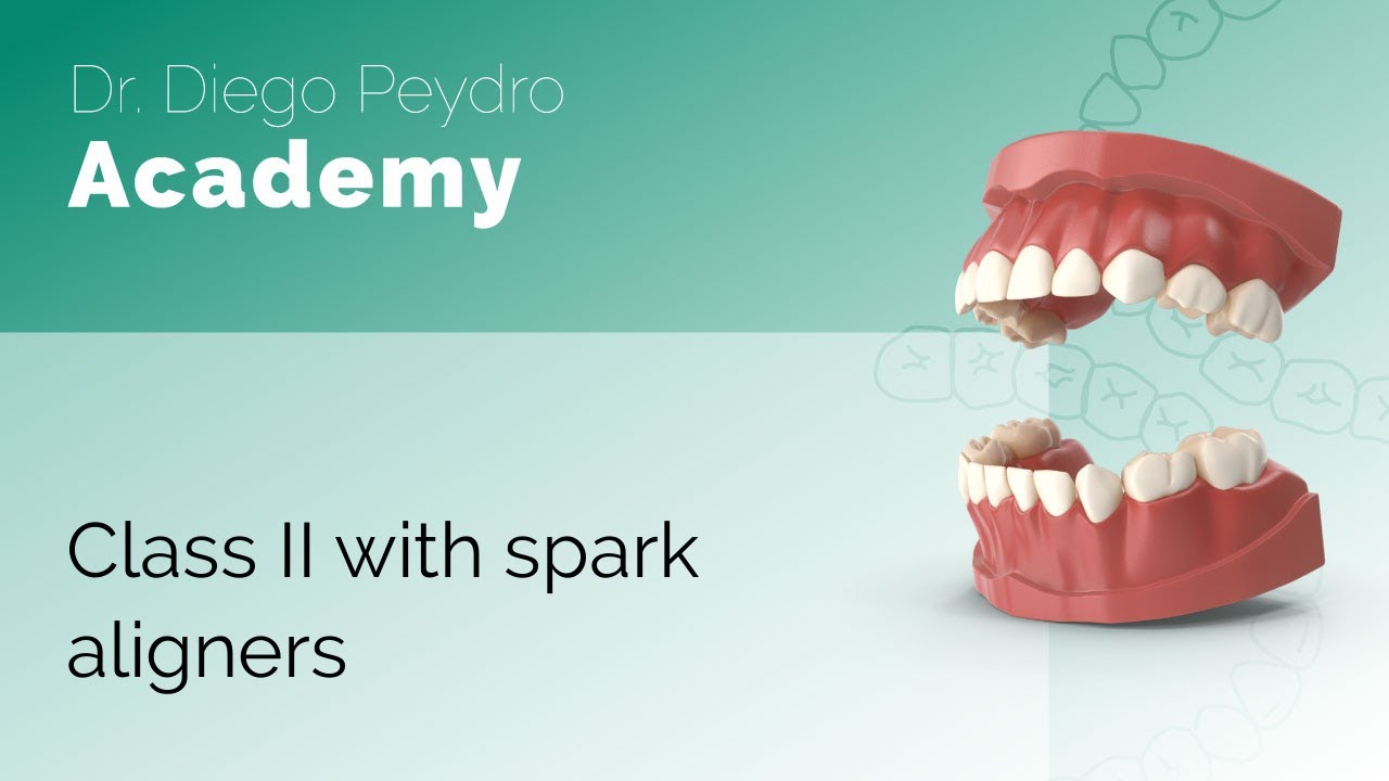 Class II with spark aligners