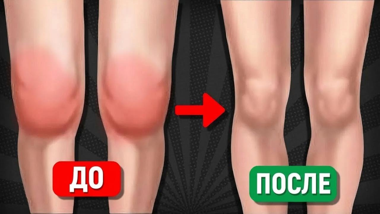 5 упражнений против отёка коленей и скопления жидкости