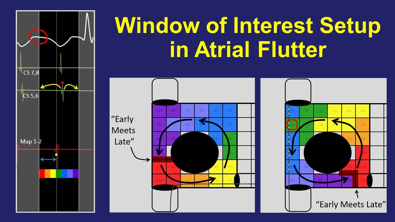 Window of Interest Setup for Atrial Flutter