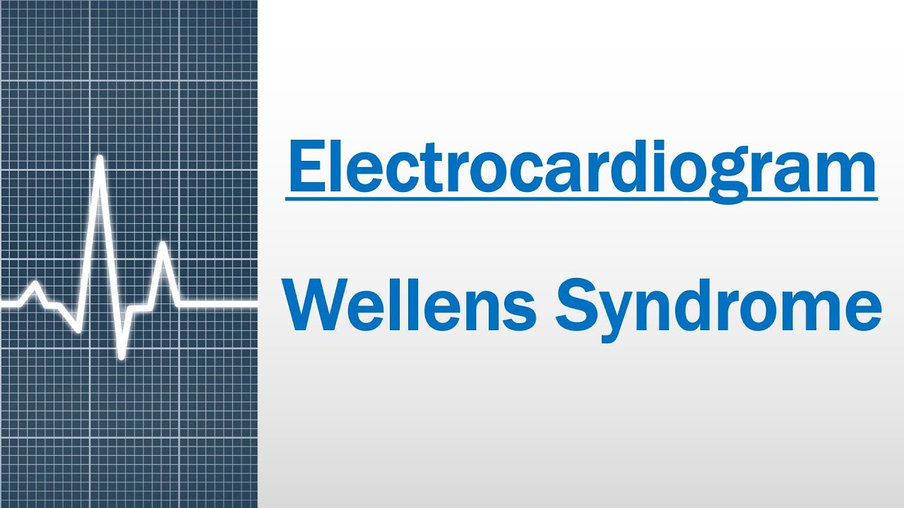 Wellens Syndrome - Diagnostic criteria and Pathophysiology [Electrocardiogram]