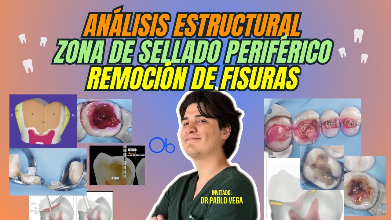 Análisis estructural, zona de sellado periférico y remoción de fisuras 🦷 con Dr Pablo Vega