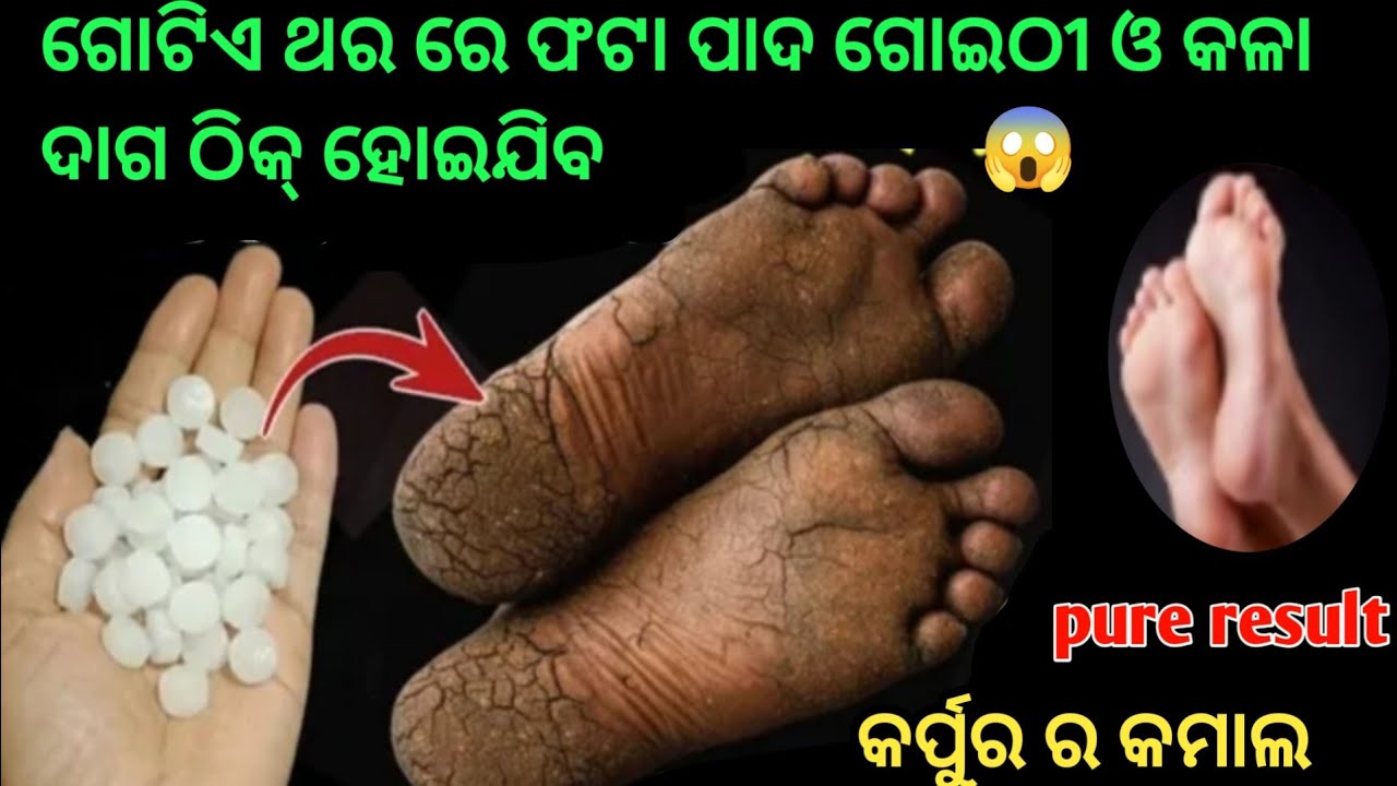 କେବଳ ଗୋଟିଏ ଥର ରେ ଠିକ୍ ହେବ ଫଟା ପାଦ ଗୋଇଠୀ ଓ ଆଣ୍ଠୁ ଗଣ୍ଠି ଦରଜ 😱 ଏହି ଜବରଦସ୍ତ ଉପାୟ 