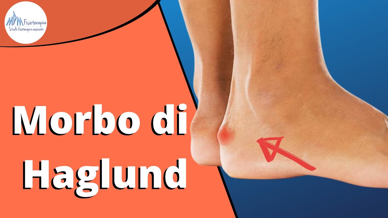 Morbo di Haglund - Gonfiore, Dolore Dietro al Tallone Risolvilo così!