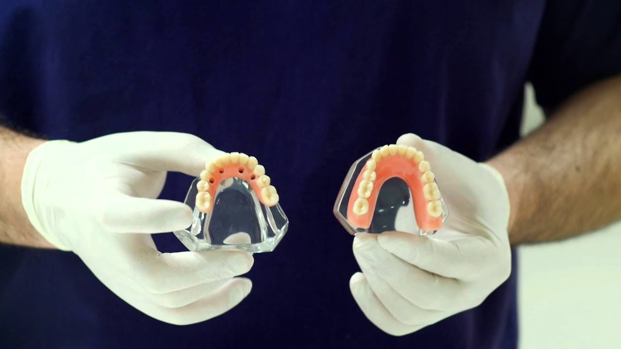Overdenture On implants vs Teeth on 4 dental implants