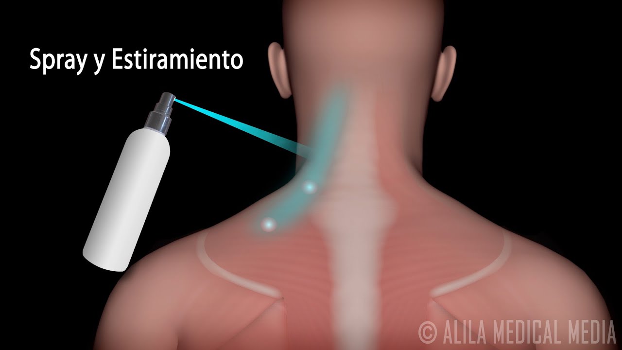 Síndrome del Dolor Miofascial y el Tratamiento de los Puntos Gatillo. Alila Medical Media Español.