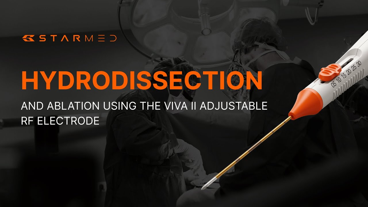 Hydrodissection and Ablation Using the VIVA II Adjustable RF Electrode